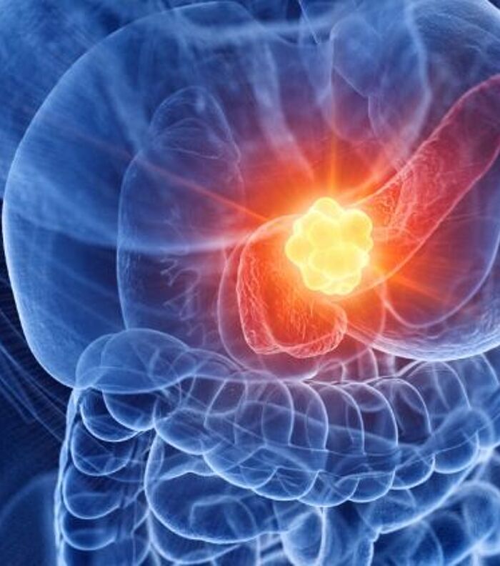 Pancreatic Cancer: Causes, Symptoms & Effective Treatment