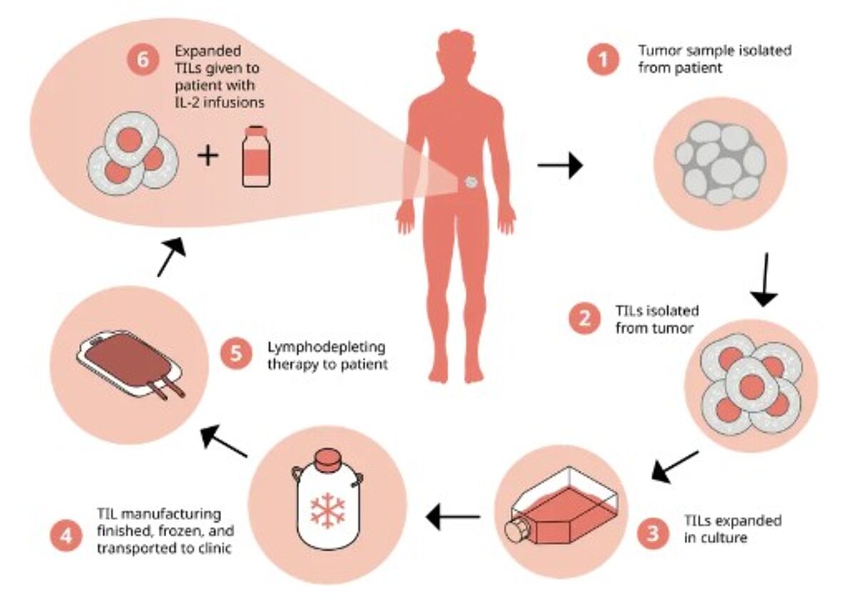 Tumor-infiltrating lymphocytes (TILs) are harvested directly from a patient's tumor tissue. After being isolated from the extracted tumor, TILs are cultivated to increase their numbers significantly and then reintroduced into the patient's body.