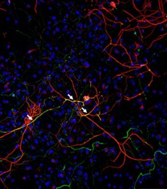 Oligomeric Proteins in Neurodegenerative Diseases