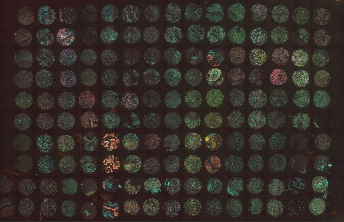 MUSE® 4-plex immunofluorescence on paired FFPE cores (breast cancer)