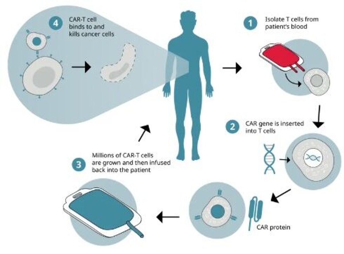 Collected immune cells undergo genetic engineering in the lab introducing the chimeric antigen receptor (CAR) gene to give them the ability to recognize cancer cells and enhance their capacity to kill them. These new CAR-T cells are then expanded in culture before being infused back into the patient. 